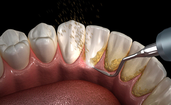 Illustration of a dental cleaning being done