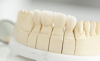 Model of the mouth with a dental bridge over four teeth