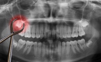 X rays of wisdom teeth prior to extraction