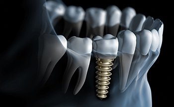 Illustrated dental implant with dental crown in lower jaw
