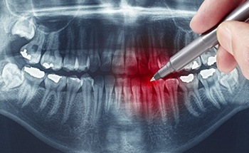 Dental x rays with some teeth highlighted red