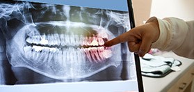 Hand pointing to x rays of teeth on computer