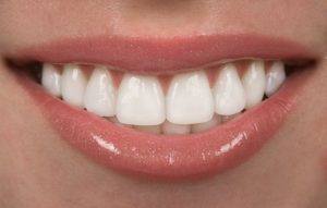 smile porcelain veneers